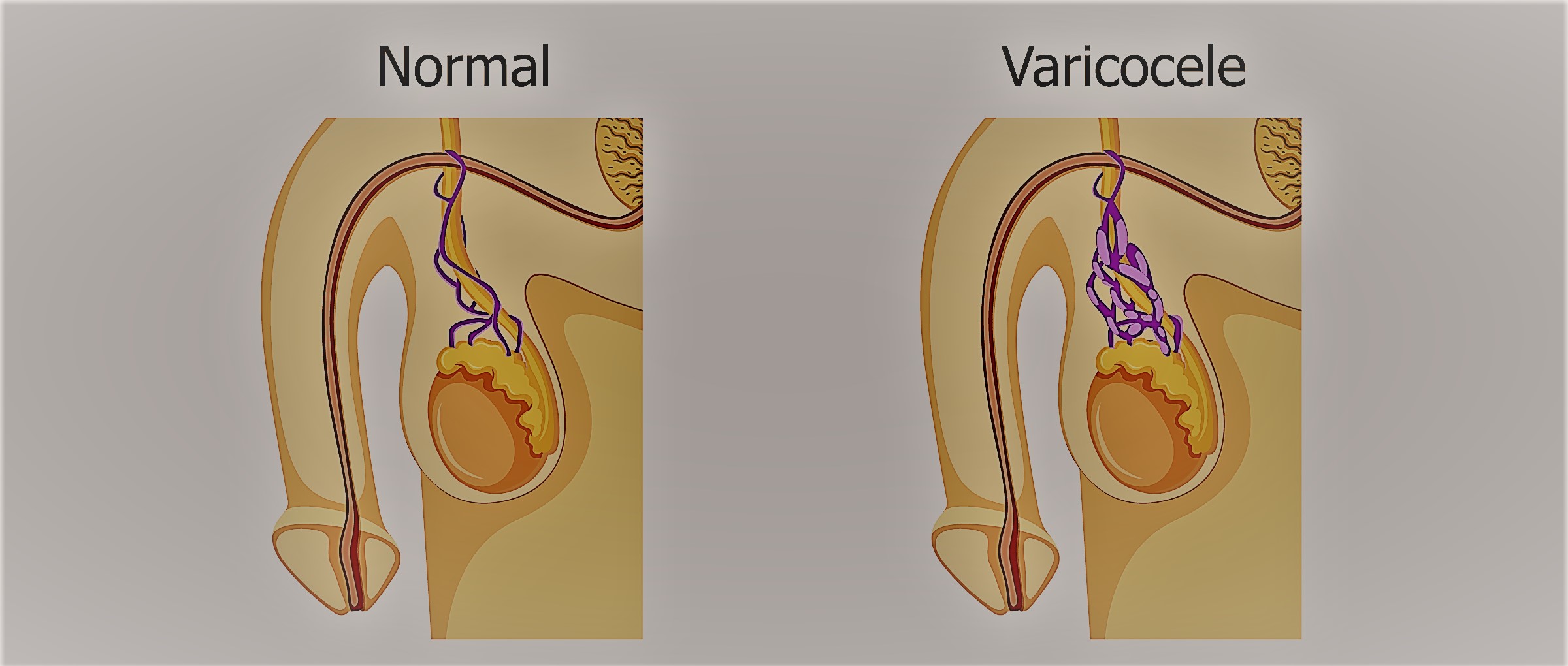 diagnosticarea varicozei în ceea ce divor