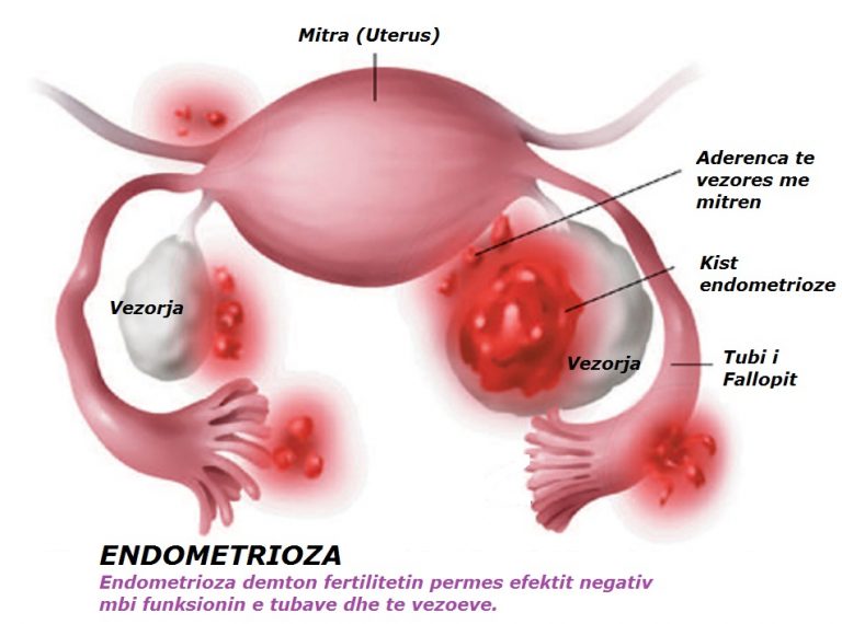 Aguacate y endometriosis